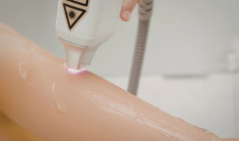 Depilacion laser