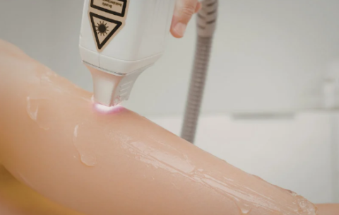 Depilacion laser