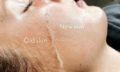 Dermaplaing