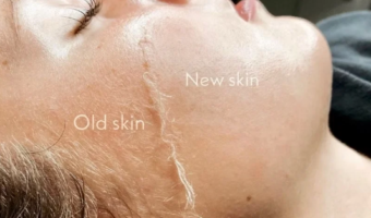 Dermaplaing