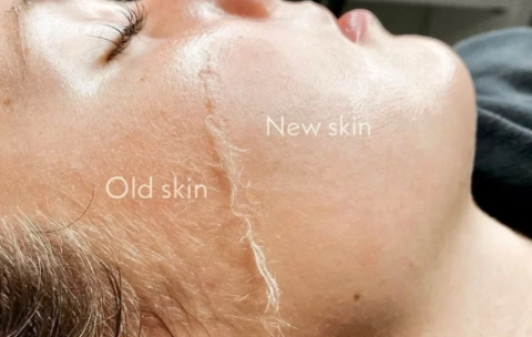 Dermaplaing